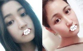 花2W多價格找深圳美加美周國偉做自體肋軟骨鼻綜合值了