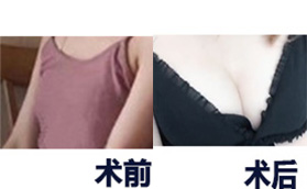 長(zhǎng)沙雅美醫(yī)療美容醫(yī)院隆胸手術(shù)案例對(duì)比圖