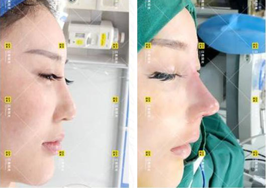 深圳江南陽光隆鼻失敗修復(fù)手術(shù)價格合理 找羅雄鵬做鼻綜合