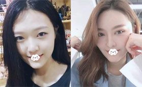 趁價(jià)格優(yōu)惠找深圳美麗方案整形姚堯做鼻綜合隆鼻+雙眼皮