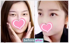 沈陽(yáng)星美王志濤切開(kāi)雙眼皮+去皮+去脂+翹睫案例