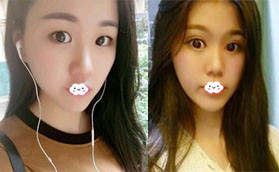 在深圳美顏?zhàn)鲅鄄空魏笾罏槭裁醋鲭p眼皮都要開眼角