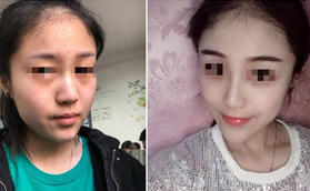 武漢檸悅給我做的12800元鼻綜合很靠譜，前后對比照片也自然