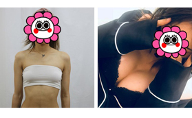 天生平胸不自信找昆明韓辰陳寧做曼托假體隆胸后值得推薦