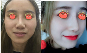 在金華瑞麗整形硅膠假體隆鼻失敗修復(fù)，成功找回了自信！