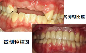 韓國登騰種植牙價(jià)格比奧齒泰便宜,但質(zhì)量并不差,和真牙一樣