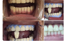 牙齒發(fā)黃的我,在南京雅度口腔做完皓齒美白后對比照片分享