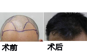 長沙協(xié)雅整形美容醫(yī)院毛發(fā)移植案例