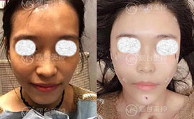 煙臺美神科美整形美容醫(yī)院面部自體脂肪填充前后對比案例