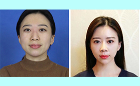 青島壹美天成整形美容醫(yī)院楊寧雙眼皮+開眼角案例