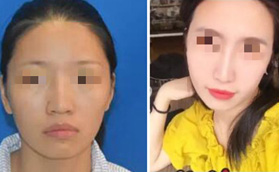 真實(shí)投稿武漢亞韓趙貴慶磨骨案例，4萬(wàn)就能讓臉型明顯改變