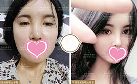 北京奧美定取出哪家好？柏麗李勁良取出之后做鼻綜合案例