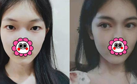 想知道太原麗都楊明峰眼睛做的咋樣,來看看我的雙眼皮變化