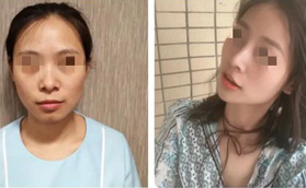 了解武漢美基元汪福強(qiáng)口碑后，找他做鼻綜合手術(shù)花了3萬多