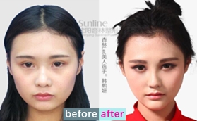 沈陽杏林整形醫(yī)院朱石江下頜角縮小術+硅膠隆鼻案例