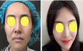 韋元強(qiáng)脂肪豐面兩萬元起看北京艾瑪面部填充案例及價(jià)格表