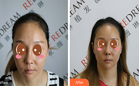 花兩萬多找北京薇琳竇云軻做發(fā)際線種植七天恢復(fù)圖