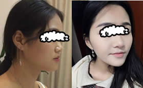 重慶聯(lián)合麗格黨寧做射極峰膨體隆鼻,一年后高度沒(méi)變矮很多