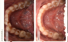 ?經(jīng)過太原眾牙1年的隱形牙齒矯正感覺隱適美的缺點就是貴