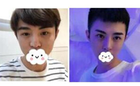 景德鎮(zhèn)圣嘉麗醫(yī)療美容鼻部綜合整形前后對(duì)比