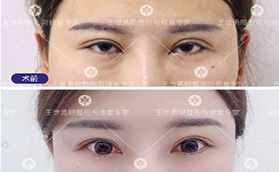 王世勇修復雙眼皮多少錢？案例價格表看北京東方百合正規(guī)