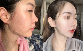 武漢華美付國(guó)友磨骨技術(shù)怎么樣？看我花了3萬(wàn)找他做下頜角