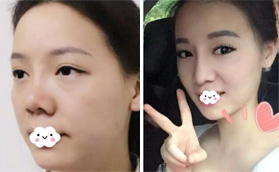 我的鼻綜合修復花了2W多，大家看深圳盛美佳隆鼻整形怎么樣