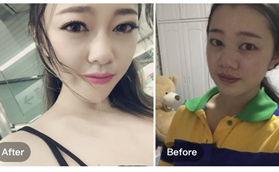 南京河西美容醫(yī)院方新友眼綜合修復+鼻綜合案例分享