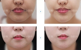 沈陽安娜寶士麗徐云泳全面部提升，解鎖減齡新趨勢(shì)