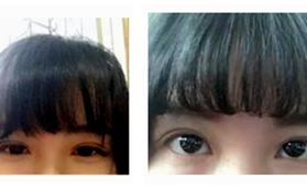 南京維多利亞美容醫(yī)院劉健切開雙眼皮手術(shù)案例分享