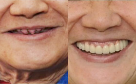 看深圳登特口腔種牙靠譜 全口種植牙價(jià)格合理做了即拔即種