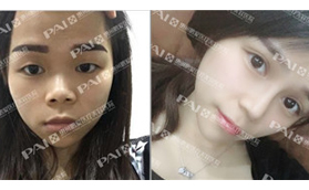 在惠州鵬愛做了開扇形雙眼皮剛拆線，就又做了耳軟骨隆鼻