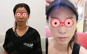 北京加減美穆寶安價(jià)格七萬多V美減齡面部提升案例分享