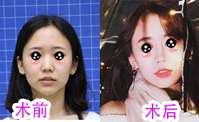 廈門微格整形張民福自體脂肪填充全臉的3個(gè)月案例對(duì)比圖