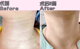 沈陽瑞妍醫(yī)療美容診所譚佳男嗨體去頸紋，美出天鵝頸