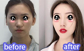 我在廈門酉西兒找莊錦波肋軟骨隆鼻100天效果對(duì)比圖