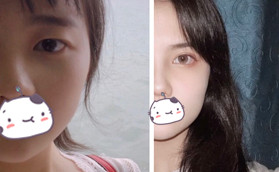 高中畢業(yè)在惠州時(shí)光做全切雙眼皮花了5000元，效果像媽生的