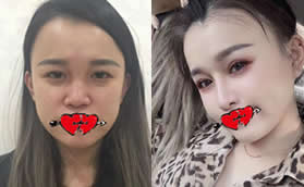 沖著重慶軍科范文亮名氣做了雙眼皮和肋骨鼻,效果太滿意了