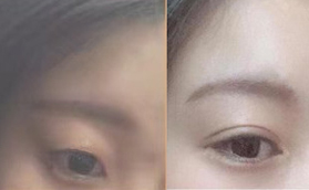 為什么我要花7380元在惠州瑞芙臣做全切7mm扇形雙眼皮