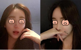 我打瑞藍玻尿酸4次山根變寬，找到惠州劉偉勇做了鼻綜合