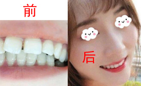 舌側(cè)貴還是隱形貴?在深圳好佰年做牙齒矯正感覺價(jià)格差不多