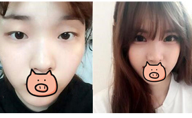 天了嚕！青海潤(rùn)美做的扇形雙眼皮竟然五天就拆線！