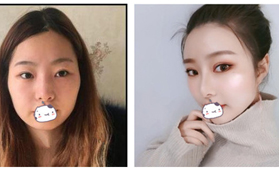 拯救小內(nèi)雙，我找蘇州圣愛胡慧敏做全切雙眼皮效果挺自然