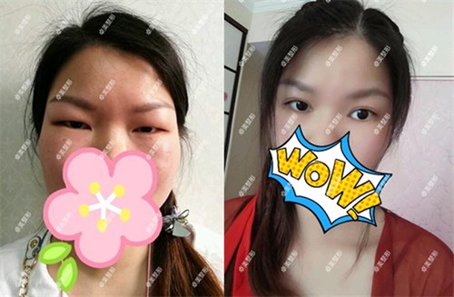 腫眼泡的我預(yù)約武漢卓美吳秀英做雙眼皮后發(fā)現(xiàn)技術(shù)很靠譜