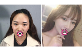 分享云南昆明銅雀臺杜亞旭做半肋骨隆鼻三個月變化效果圖