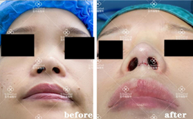 成都圣丹福整形美容醫(yī)院鼻部整形前后對比圖