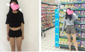 沖著武漢仁愛時(shí)光包濤口碑去做的大腿吸脂，成功抽脂1500ml