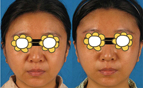 畢洪森內(nèi)窺鏡除皺多少錢(qián)？奉上北醫(yī)三院除皺案例及價(jià)格表