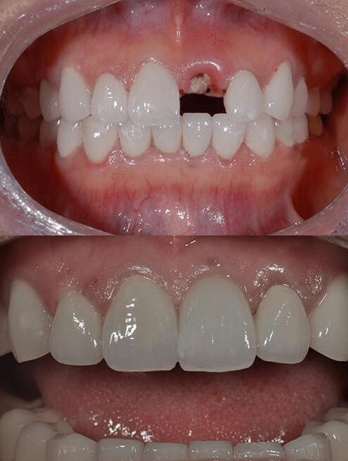 蘭州皓亞口腔種植牙怎么樣？ 韓國奧齒泰TS種植系統(tǒng)好嗎？