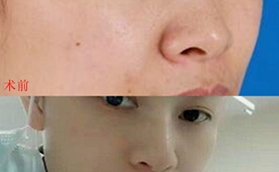 青島博士高鍔院長(zhǎng)給我做玻尿酸隆鼻，效果我很滿意！